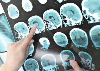 La Inteligencia Artificial ayudará a predecir la esclerosis múltiple