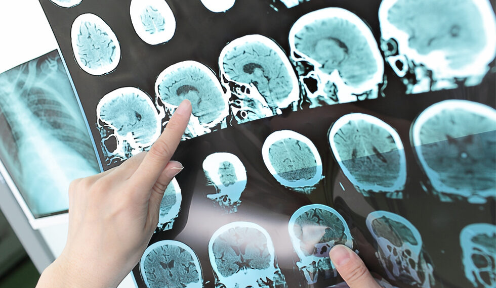 La Inteligencia Artificial ayudará a predecir la esclerosis múltiple